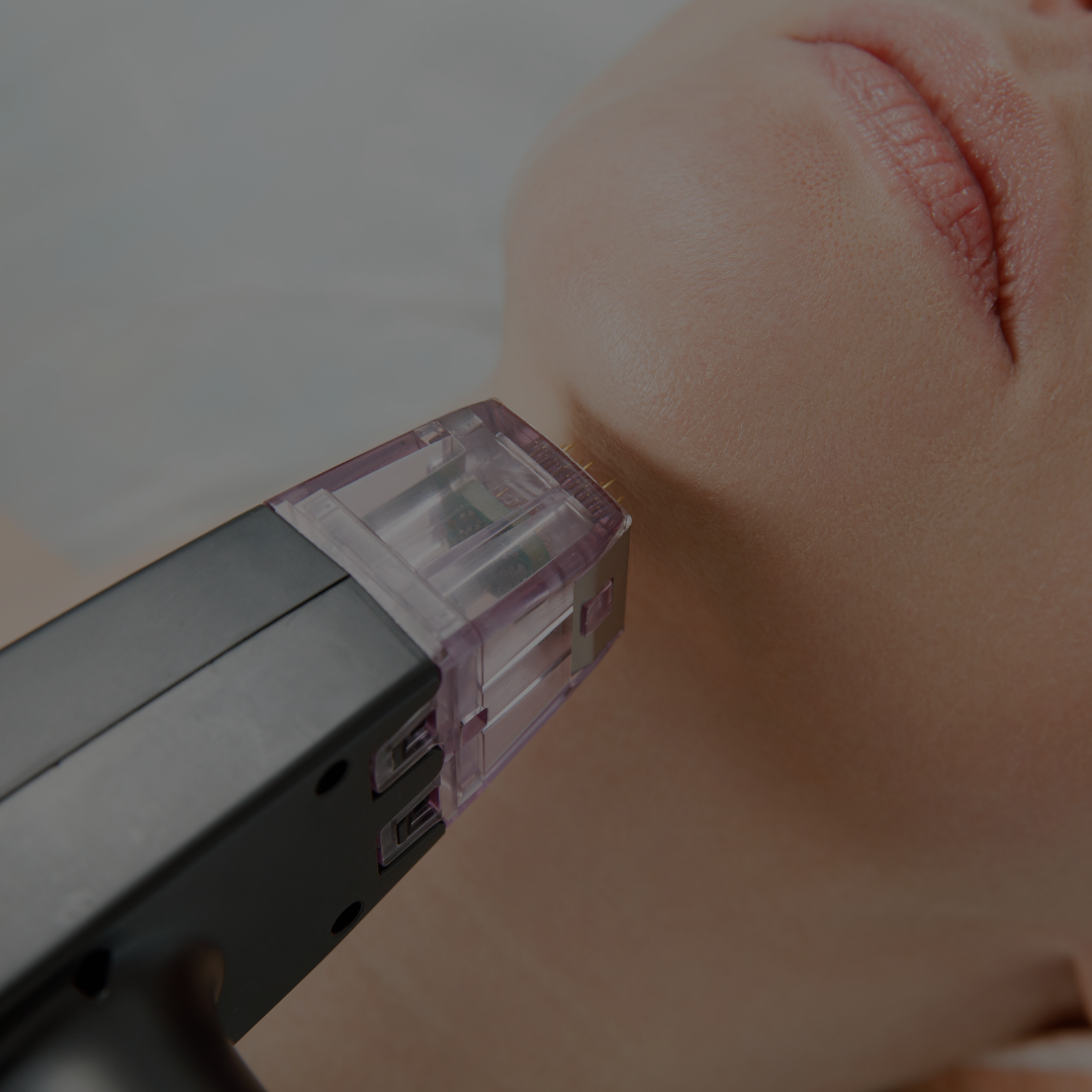 RF Microneedling behandling